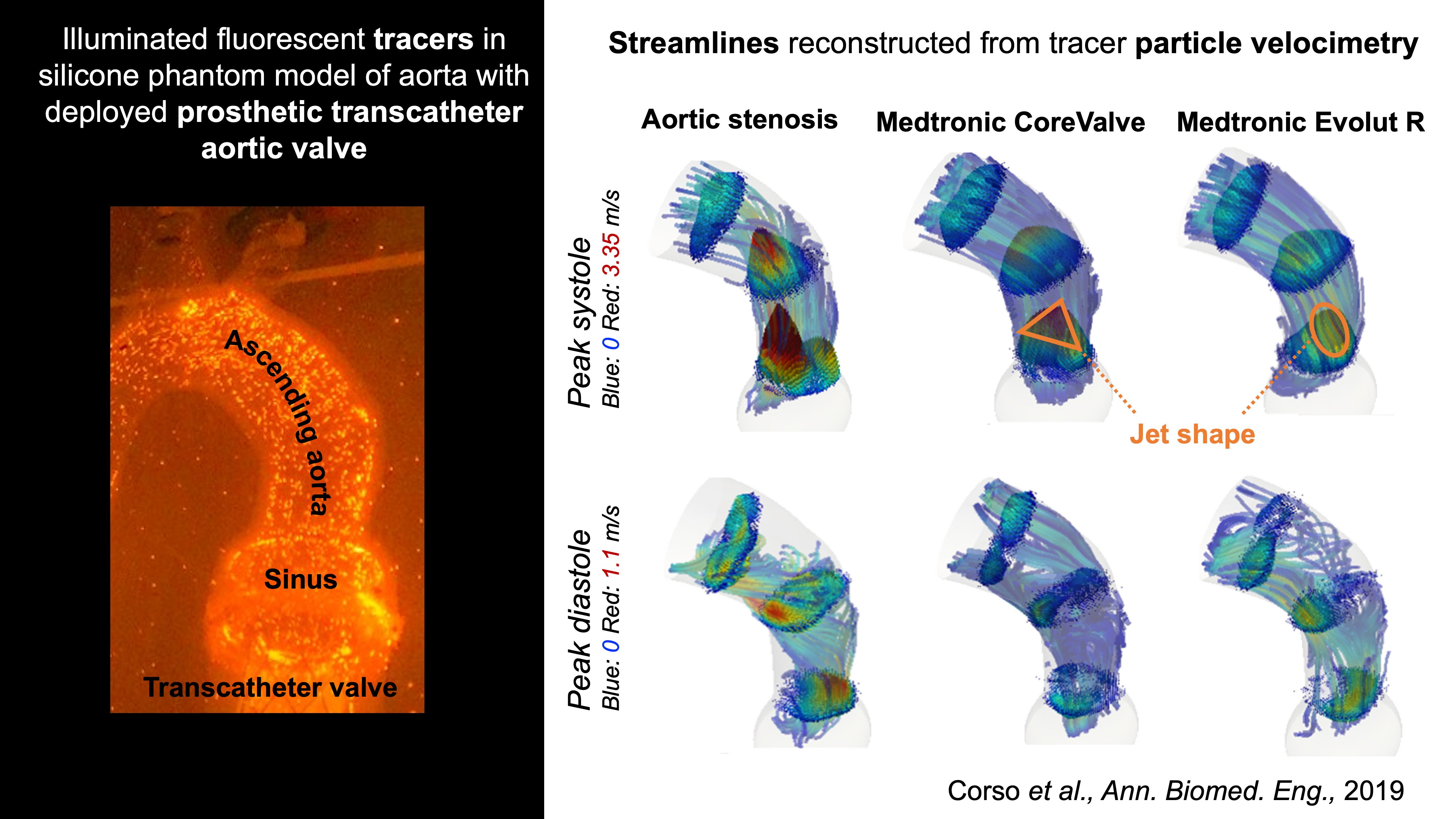 3D-PTV measurements dowsntream of stenotic and transcatheter aortic valves